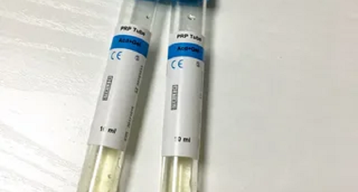 Advantages of purchasing PRP tubes in PlasmoLifting
